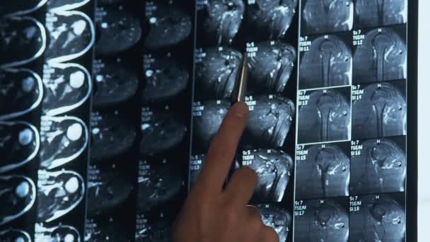 Lääkäri tutkii MRI olkapään nivelet scan
 - Materiaali, video