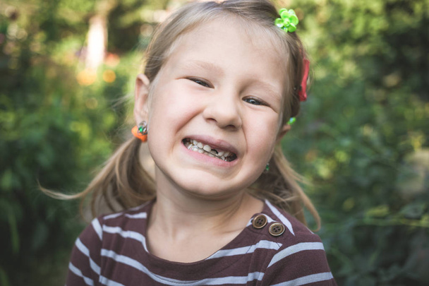 Kind mit kieferorthopädischem Gerät und ohne einen Zahn - Foto, Bild