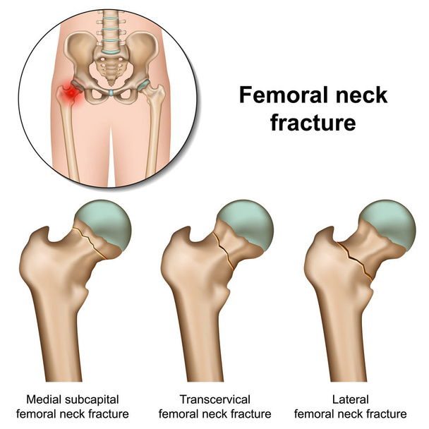 Fracturas de cuello femoral vector médico ilustración sobre fondo blanco
 - Vector, imagen