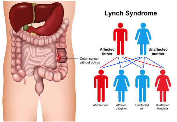 Lynch-szindróma 3d orvosi vektor illusztráció fehér háttér - Vektor, kép