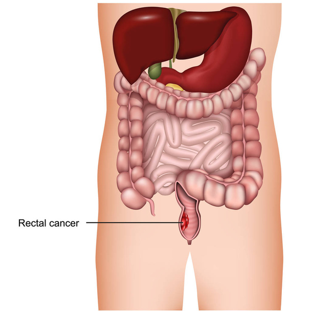 медицинская 3d векторная иллюстрация рака прямой кишки на белом фоне, колоректальный рак
 - Вектор,изображение
