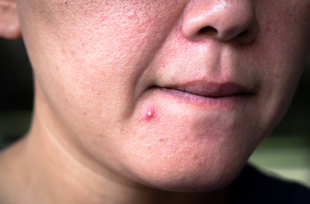 acne skin - Photo, Image