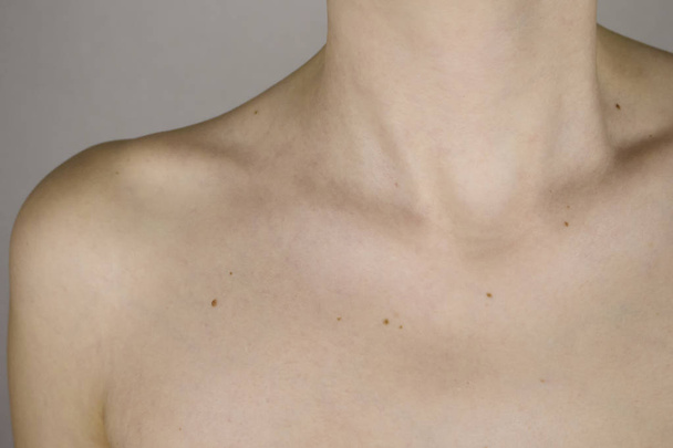 Hals und Schlüsselbein eines Mädchens mit vielen Muttermalen auf der Haut in Nahaufnahme - Foto, Bild
