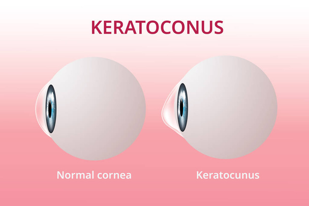Ooghoornvlies en keratoconus, oogaandoening, medische vector - Vector, afbeelding