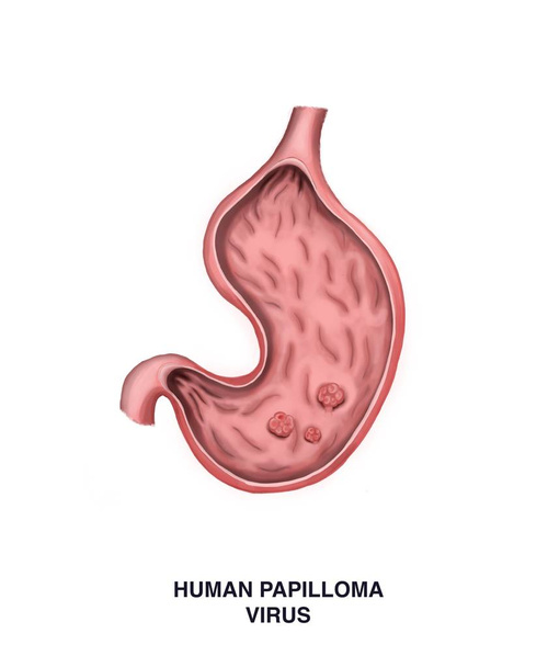 Illustration of the Human papilloma virus - Photo, Image