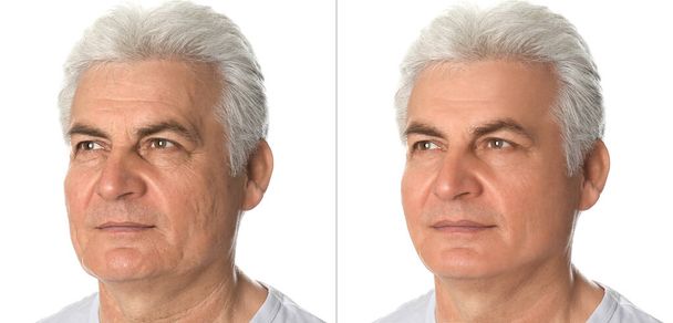 Mature man before and after plastic surgery on white background - Valokuva, kuva