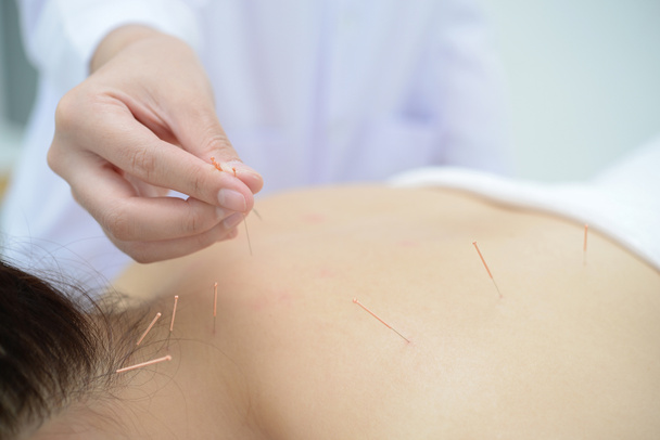 Close-up, paciente recebendo acupuntura de acupunturista na clínica
 - Foto, Imagem