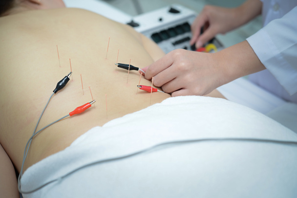 Electro Acupuncture.Traditional Chinese acupuncture and Electroa - Photo, Image