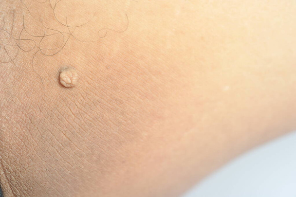 Etichetta di massa peduncolata della pelle o acrocondon o fibroma molle. Papilloma urto sul corpo maschile macro colpo sulla coscia
 - Foto, immagini