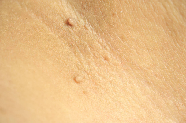 Etichetta di massa peduncolata della pelle o acrocondon o fibroma molle. Papilloma urto sul corpo maschile macro colpo sulla coscia
 - Foto, immagini