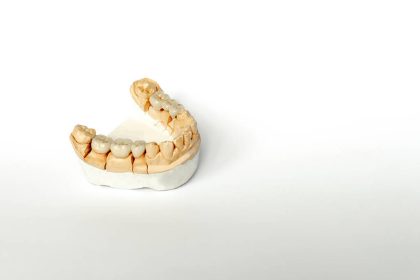 ορθοπεδική οδοντιατρική. έννοια αντικατάστασης δοντιών. οδοντικά προσθετικά - Φωτογραφία, εικόνα