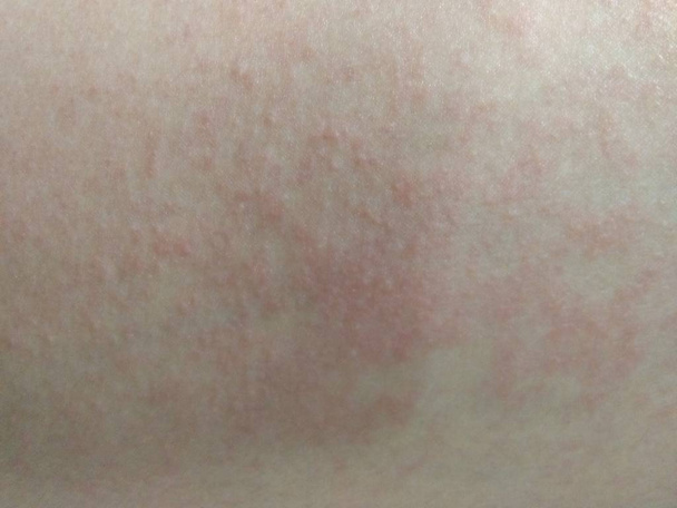 Rode huiduitslag - huidreacties op de huid van het been van vrouwen door cosmetica. - Foto, afbeelding