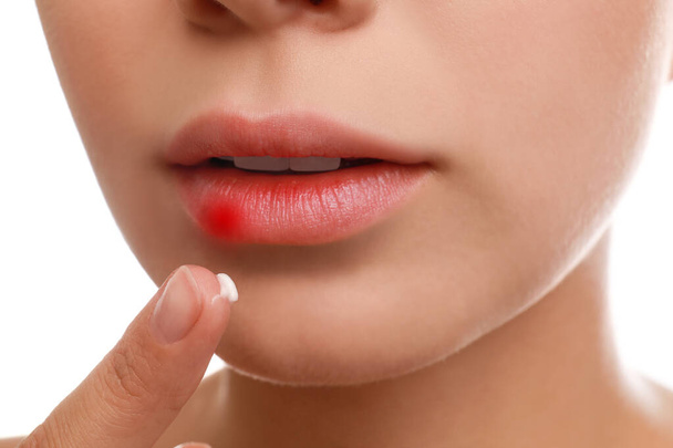Young woman with cold sore applying cream onto lips against white background, closeup - Foto, Imagem