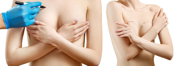 Doctor hand schilderen stippellijn op vrouwelijke borst. - Foto, afbeelding