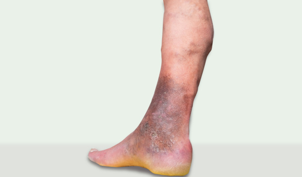 varicose veins leg ulcers3 - Photo, Image
