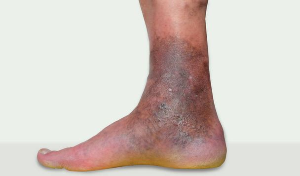 varicose veins leg ulcers - Photo, Image