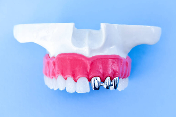 Tooth implant and crown installation process - Фото, зображення