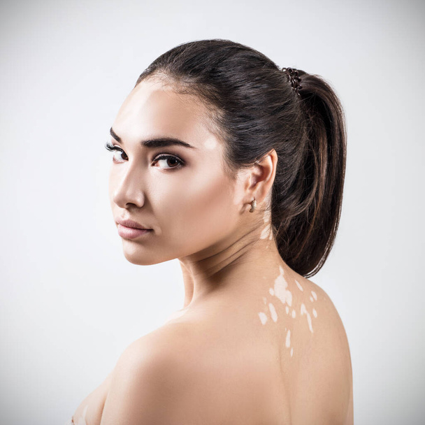 Retrato de mujer hermosa con vitiligo
. - Foto, imagen