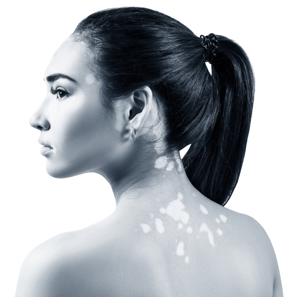 Portrait de belle femme avec vitiligo
. - Photo, image