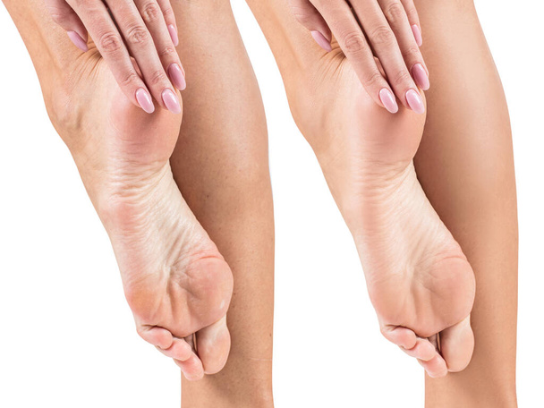 Stopy z suchą skórą, przed i po leczeniu. - Zdjęcie, obraz