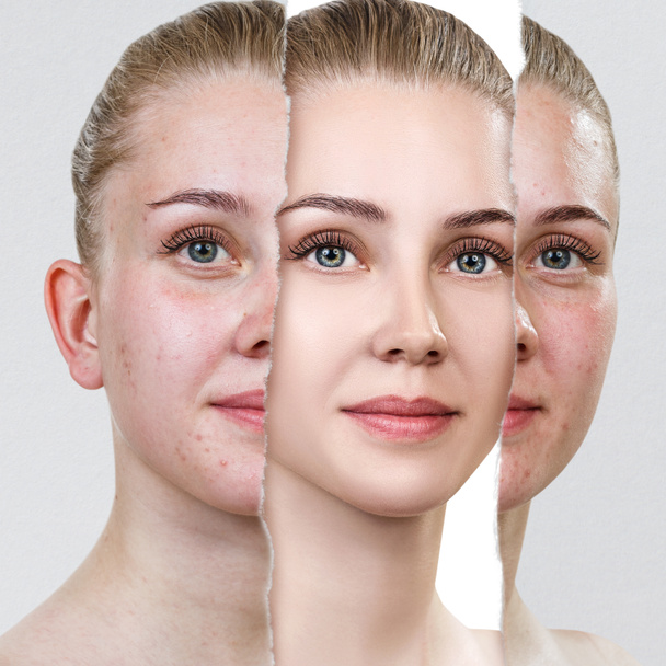 Compare of old photo with acne and new healthy skin. - Photo, Image
