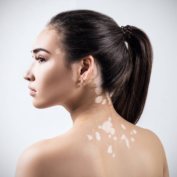 Retrato de mujer hermosa con vitiligo
. - Foto, Imagen