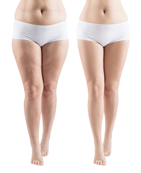Nainen jalat ennen ja jälkeen laihtumiseen
. - Valokuva, kuva