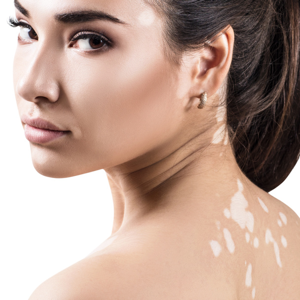 Portret van een mooie vrouw met vitiligo. - Foto, afbeelding