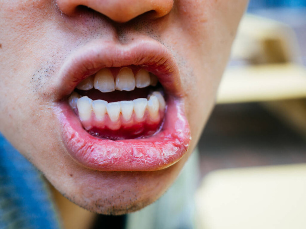 Bouche sèche et mauvaises dents d'un homme par temps froid fermer
 - Photo, image