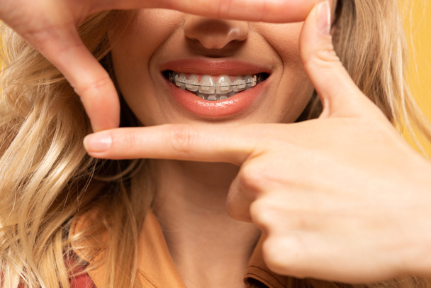 Vista recortada de mulher sorridente com aparelho dentário isolado em amarelo
 - Foto, Imagem