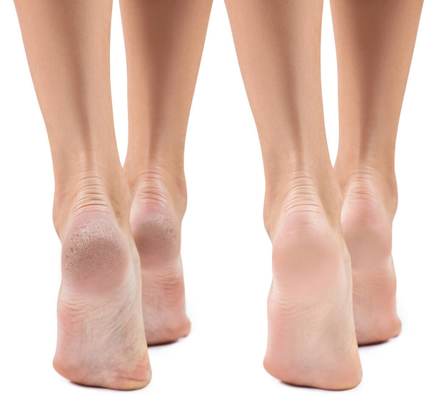 Füße mit trockener Haut vor und nach der Behandlung. - Foto, Bild