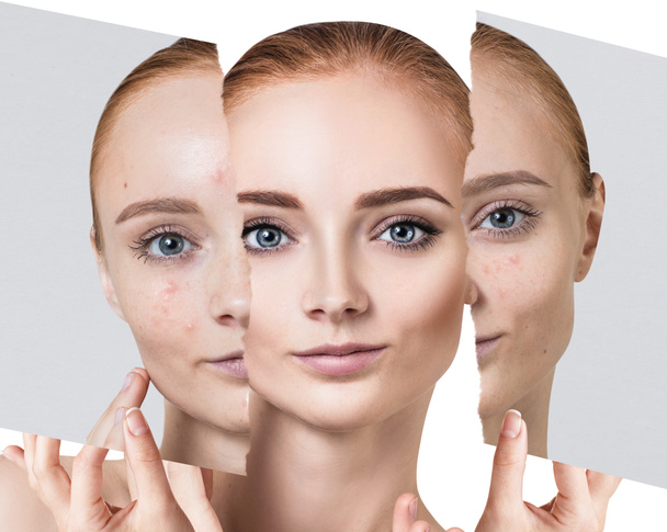 Comparer une vieille photo avec de l'acné et une nouvelle peau saine
. - Photo, image
