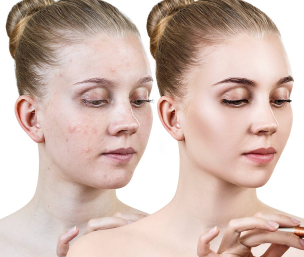 junge Frau vor und nach der Hautbehandlung. - Foto, Bild