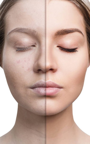 Mujer con acné antes y después del tratamiento
. - Foto, Imagen
