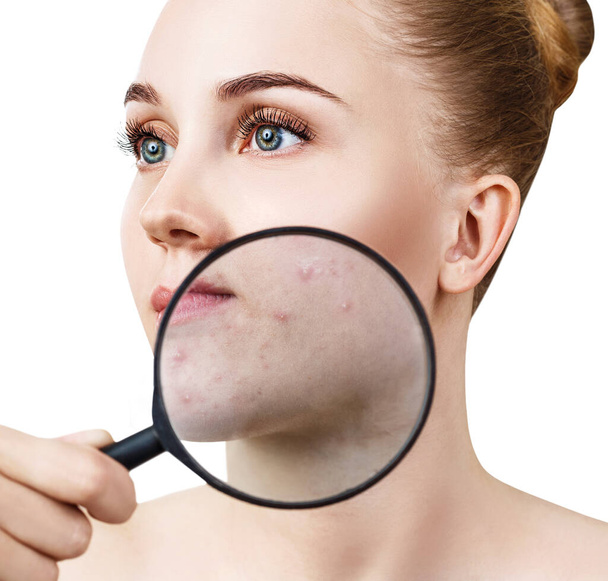 Young woman with magnifying glass shows skin with acne. - Zdjęcie, obraz