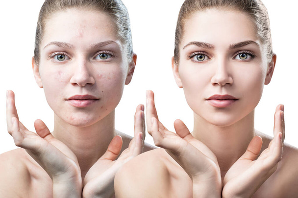 Kobieta z trądzikiem przed i po leczeniu i makijażu. - Zdjęcie, obraz