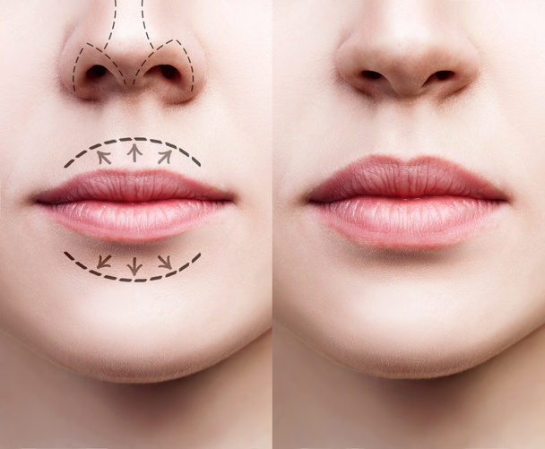 Lippen van jonge vrouw voor en na augmentatie - Foto, afbeelding