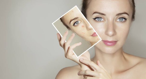 nainen kasvot muotokuva selkeä ja näppyläinen iho / ihonhoitotuotteet käsite suunnitteluun
 - Valokuva, kuva