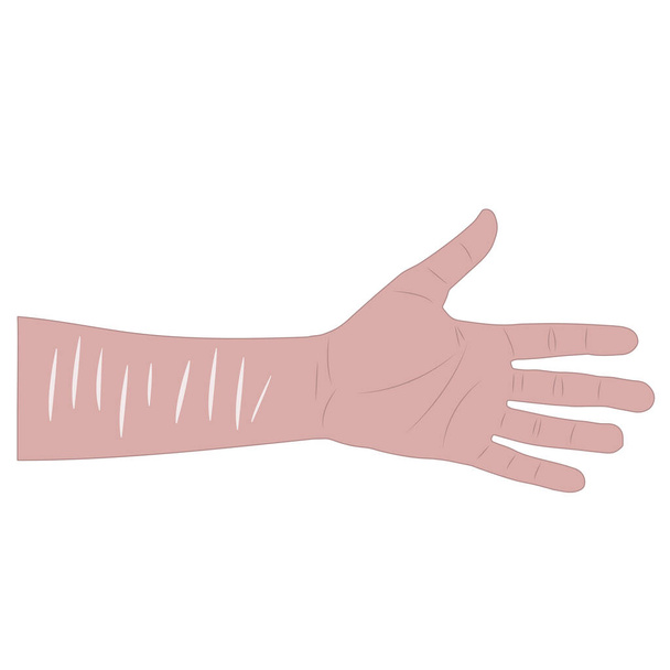 man hand met littekens op de pols na zelfmoordpoging. geïsoleerde vectorillustratie - Vector, afbeelding