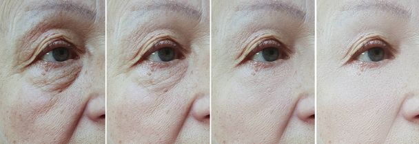 yaşlı kadın tedavi öncesi ve sonrası gözleri kırışır - Fotoğraf, Görsel