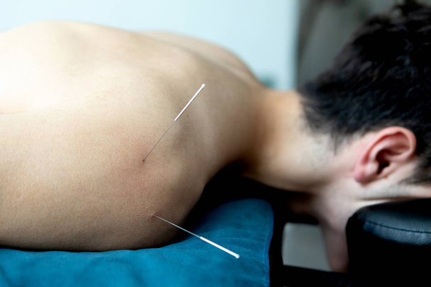 Hombre joven en una terapia de acupuntura
 - Foto, imagen