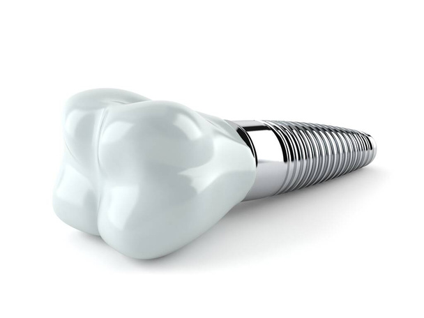 Dental implant - Valokuva, kuva