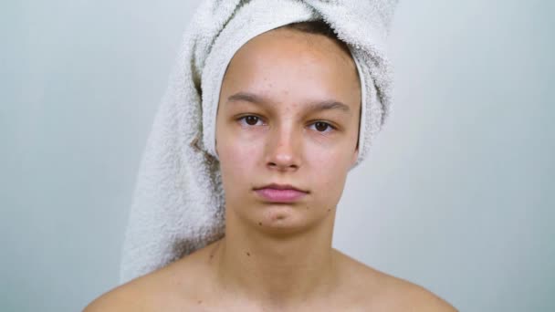 Sad teenager with acne and pimples on face in studio - Materiał filmowy, wideo