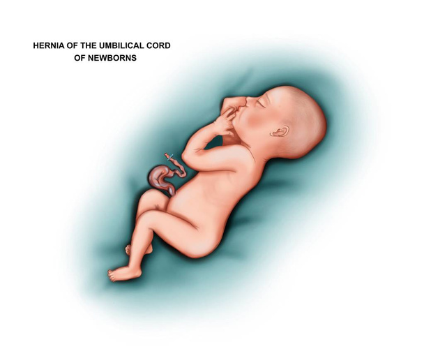 Ilustração da hérnia do cordão umbilical em um recém-nascido
 - Foto, Imagem