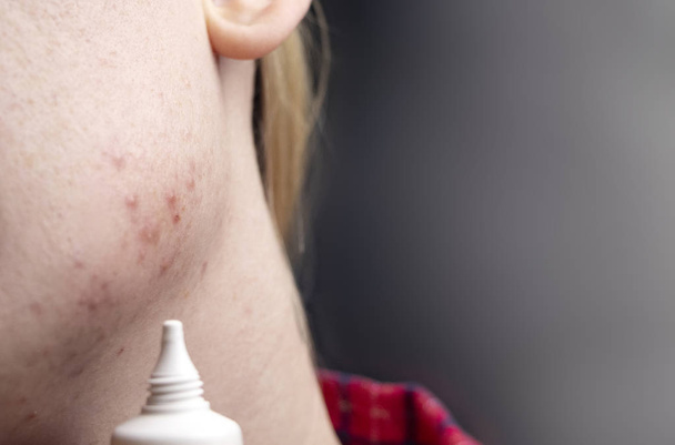 Acne op de kin: demodecose tik op de huid van het gezicht van een meisje. Patiënt bij de afspraak van een dermatoloog. Probleem huid en schoonheid concept. - Foto, afbeelding