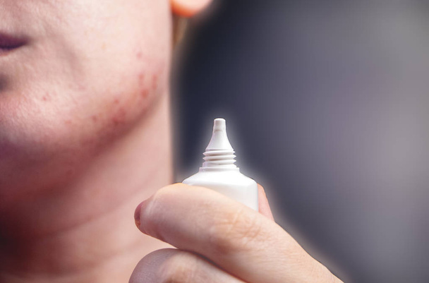 Acne op de kin: demodecose tik op de huid van het gezicht van een meisje. Patiënt bij de afspraak van een dermatoloog. Probleem huid en schoonheid concept. - Foto, afbeelding
