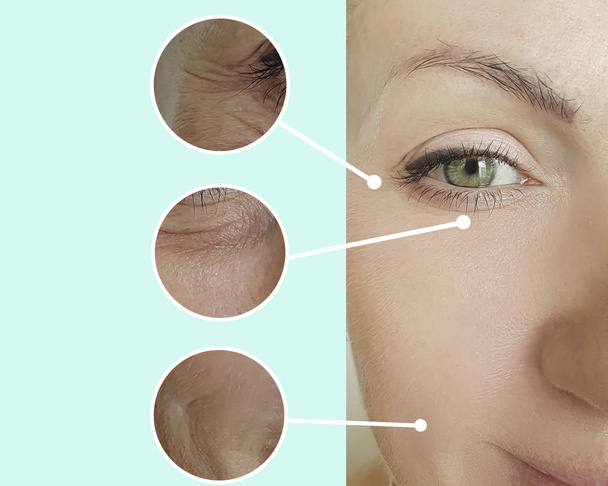 arrugas de la mujer cara antes y después del tratamiento
 - Foto, imagen