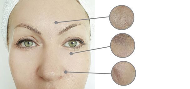 Frauenfalten im Gesicht vor und nach der Behandlung - Foto, Bild