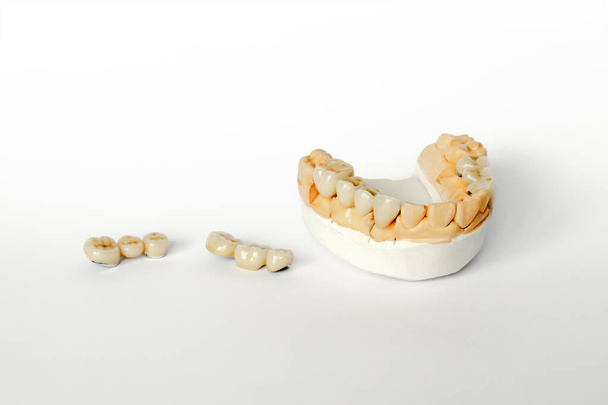 orthopedische tandheelkunde. tandvervanging concept. kunstgebit. cermet tanden. keramische bruggen. gips model van de kaak en tanden. Witte achtergrond - Foto, afbeelding