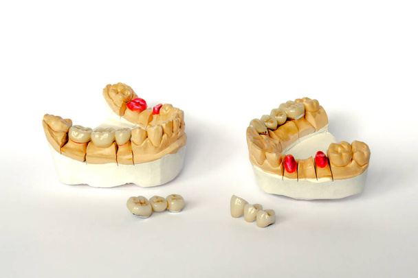 concept of orthopedic dentistry. dental prosthetics with ceramic crowns and bridges. dental bridges on the posterior teeth - Photo, Image